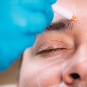 تزریق فیلر زیر چشم_ها برای آقایان