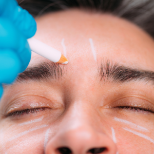 تزریق فیلر پیشانی و خطوط میان ابرو برای آقایان