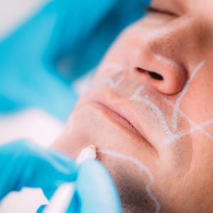 تزریق فیلر چانه و خط فک برای آقایان