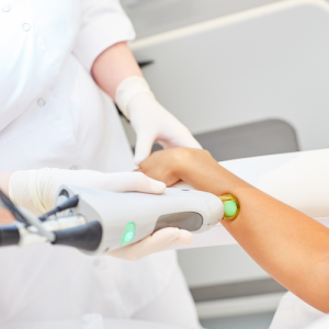 لیزر موهای زائد با دستگاه کندلا