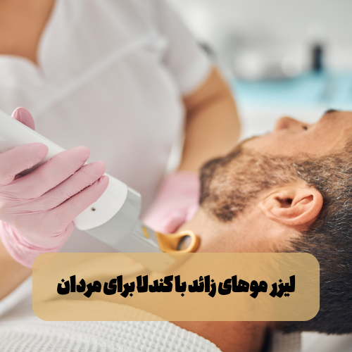 لیزر موهای زائد با کندلا برای مردان