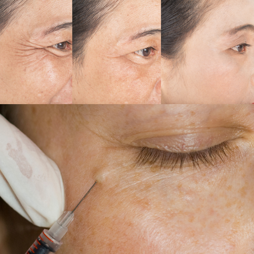 تزریق بوتاکس برای رفع چین و چروک