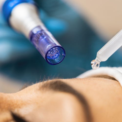 میکرونیدل با کوکتل تخصصی