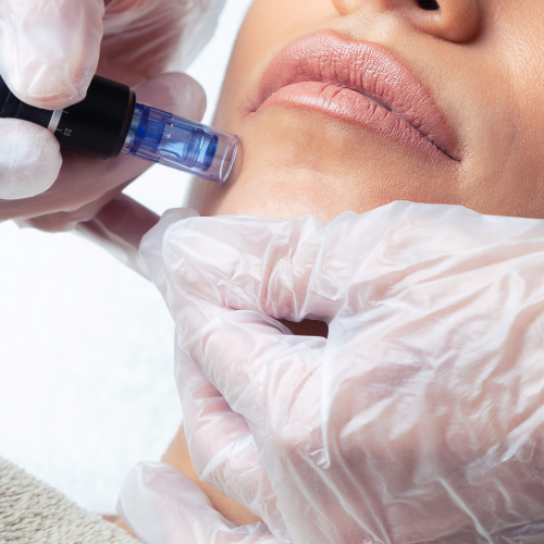 میکرونیدلینگ برای جای جوش