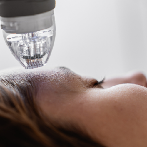 میکرونیدلینگ برای جوانسازی پوست