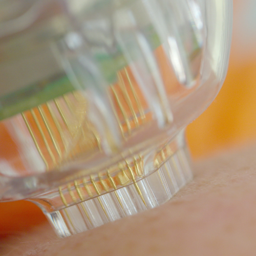 میکرونیدلینگ در اندیشه