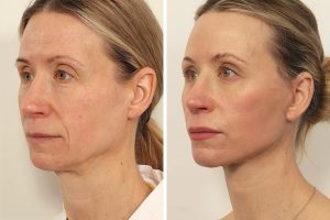 قیمت فیلر صورت