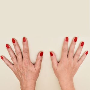 فیلر پشت دست