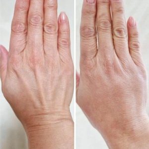 جوانسازی دست با تزریق ژل