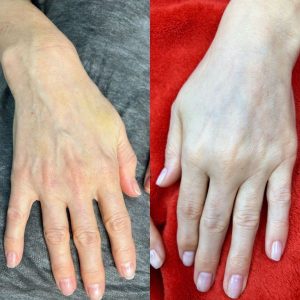 انجام جوانسازی دست با فیلر چگونه صورت می گیرد؟