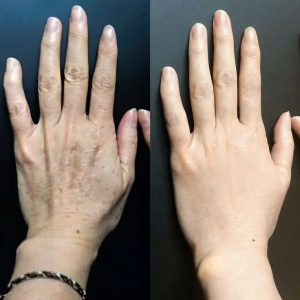 فواید جوانسازی دست