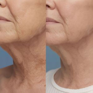 جالپرو پوست گردن در اندیشه