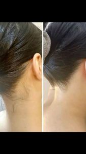 کربن تراپی پشت گردن در تهران