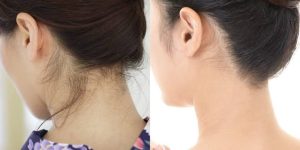 بهترین دستگاه کربن تراپی