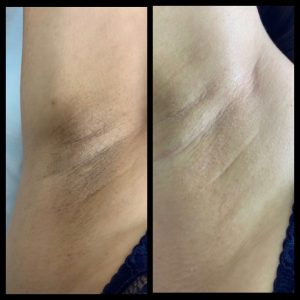 هزینه کربن تراپی زیر بغل