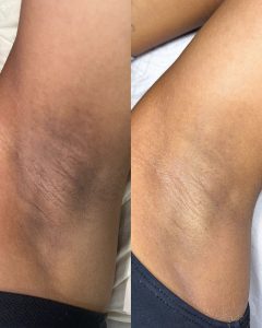 پیلینگ هالیوودی زیربغل