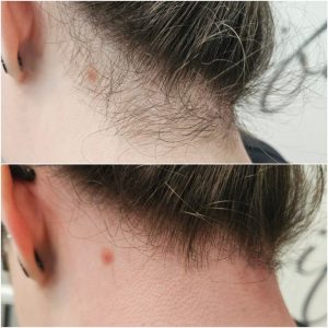 عکس قبل و بعد کربن تراپی