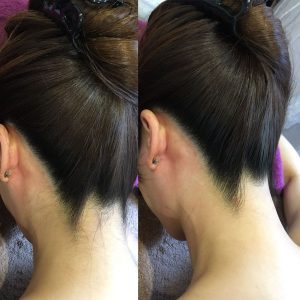 کربن تراپی پشت گردن