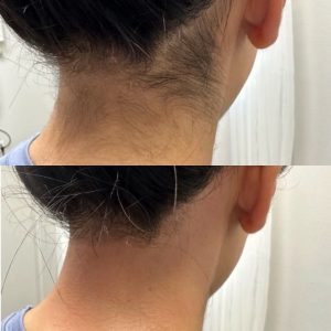 مزایا کربن تراپی پشت گردن