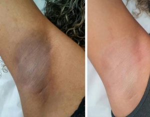 کربن تراپی زیر بغل چند جلسه است