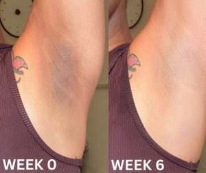 عکس قبل و بعد کربن تراپی زیربقل