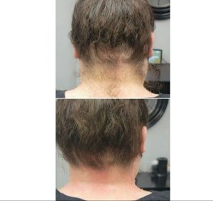 قیمت کربن تراپی پشت گردن