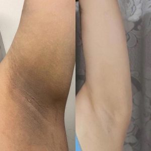 وایتنینگ زیر بغل