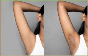 مزایا کربن تراپی زیربغل