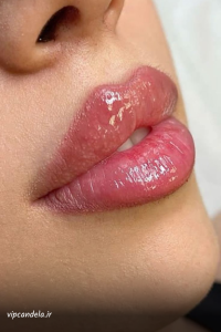 مراقبت بعد از تزریق ژل لب