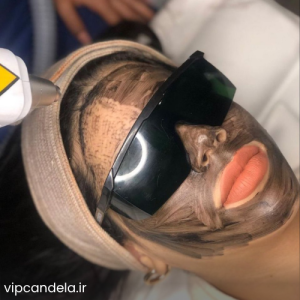 فیلم کربن تراپی صورت