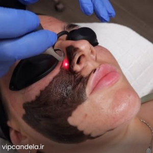 عکس قبل و بعد کربن تراپی صورت