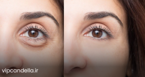 تزریق فیلر در اندیشه